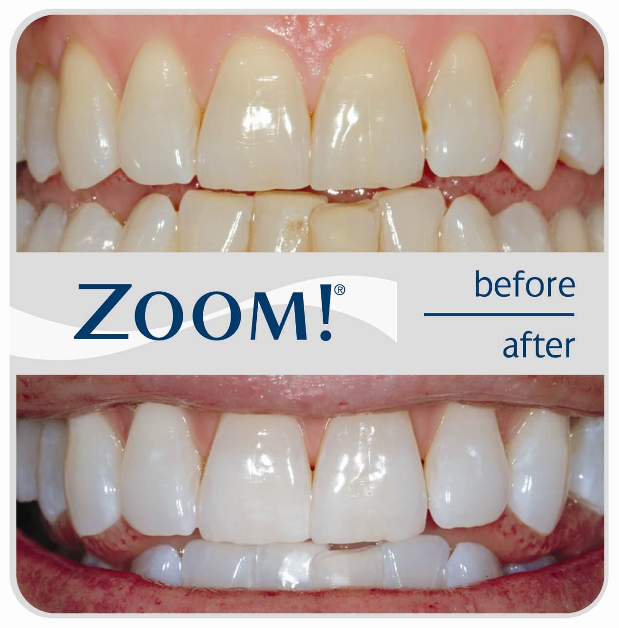 Before And After Zoom Teeth Whitening