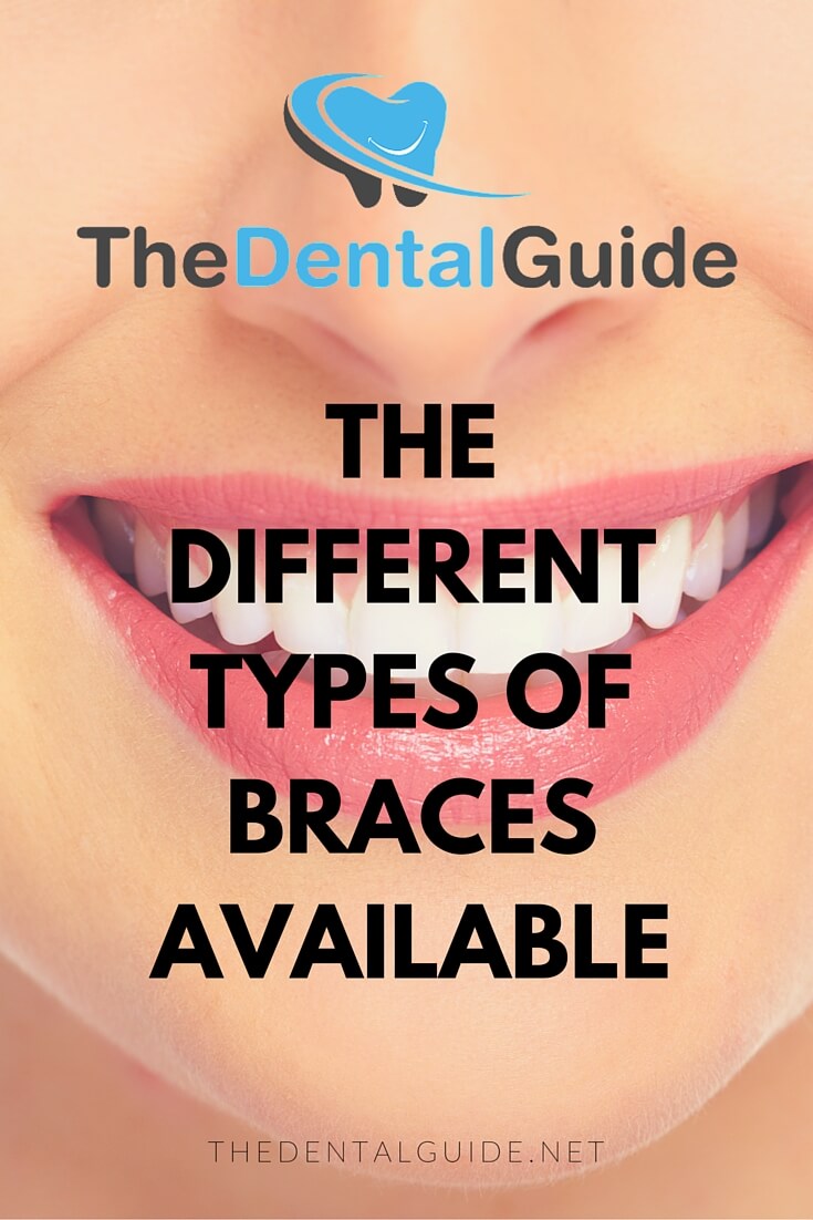 What are some different types of braces?