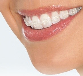 Ceramic Braces For Adults 83