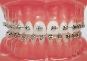 Damon braces