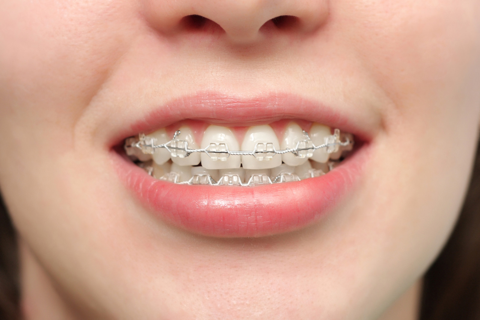 How Much Do Braces Cost in the UK? - The Dental Guide UK