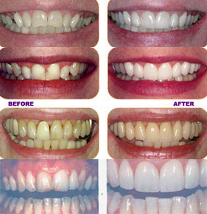 Dental Implants from Celeb Jaws Health