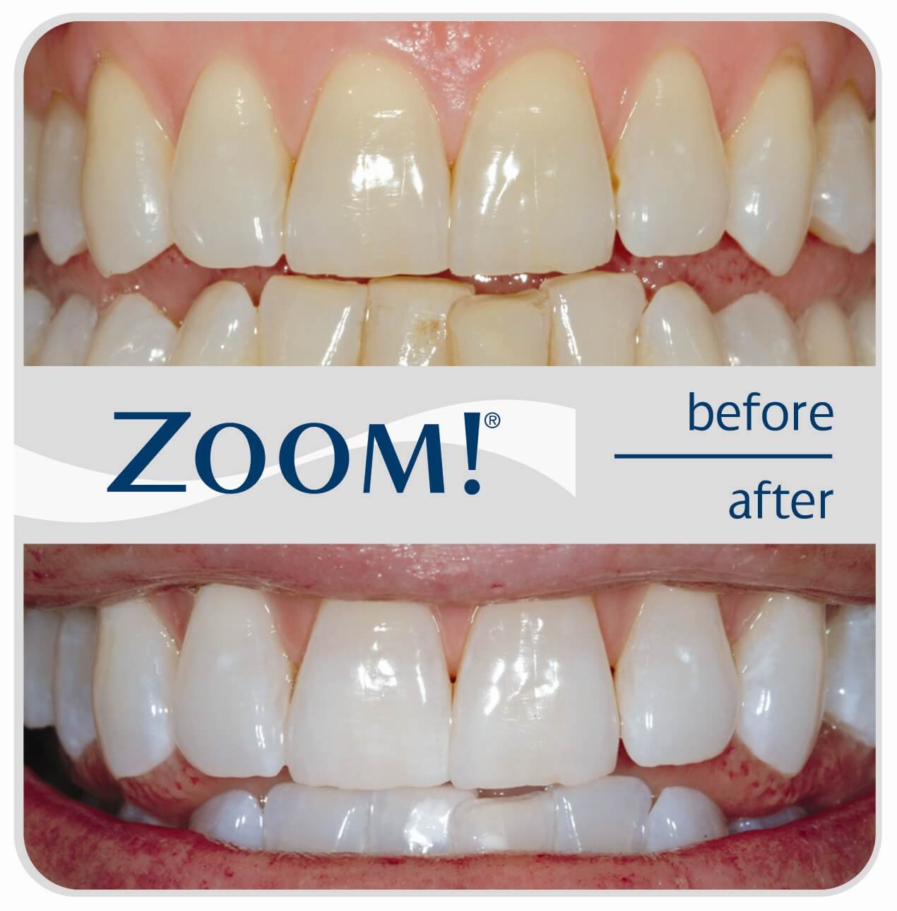 does zoom whitening hurt