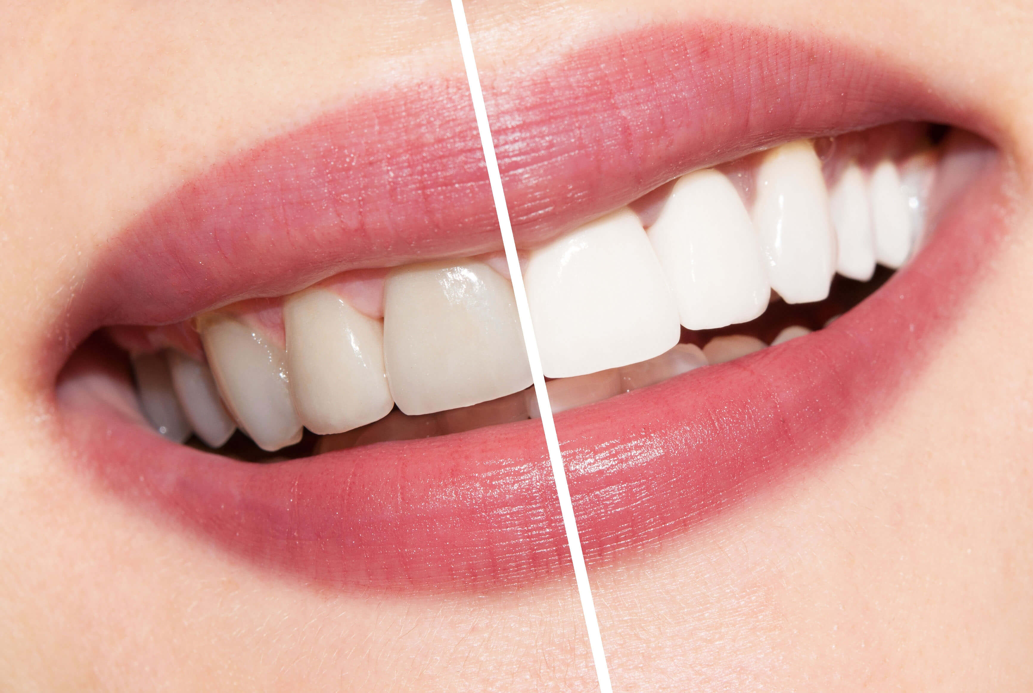 Teeth Whitening Costs and Information - The Dental Guide