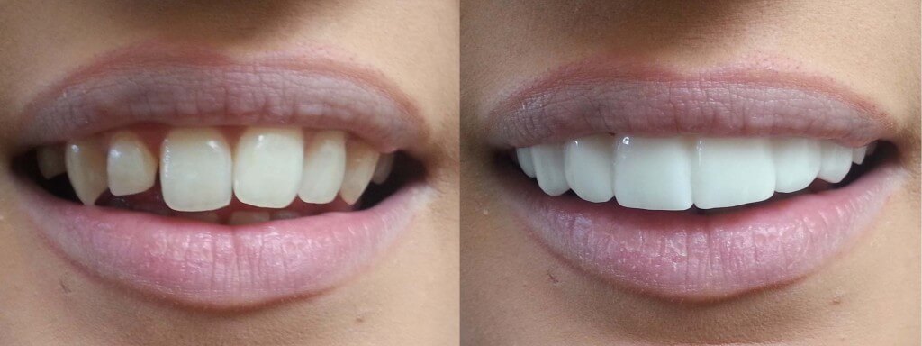 clip-on-veneers-bleach-shade-before-afters