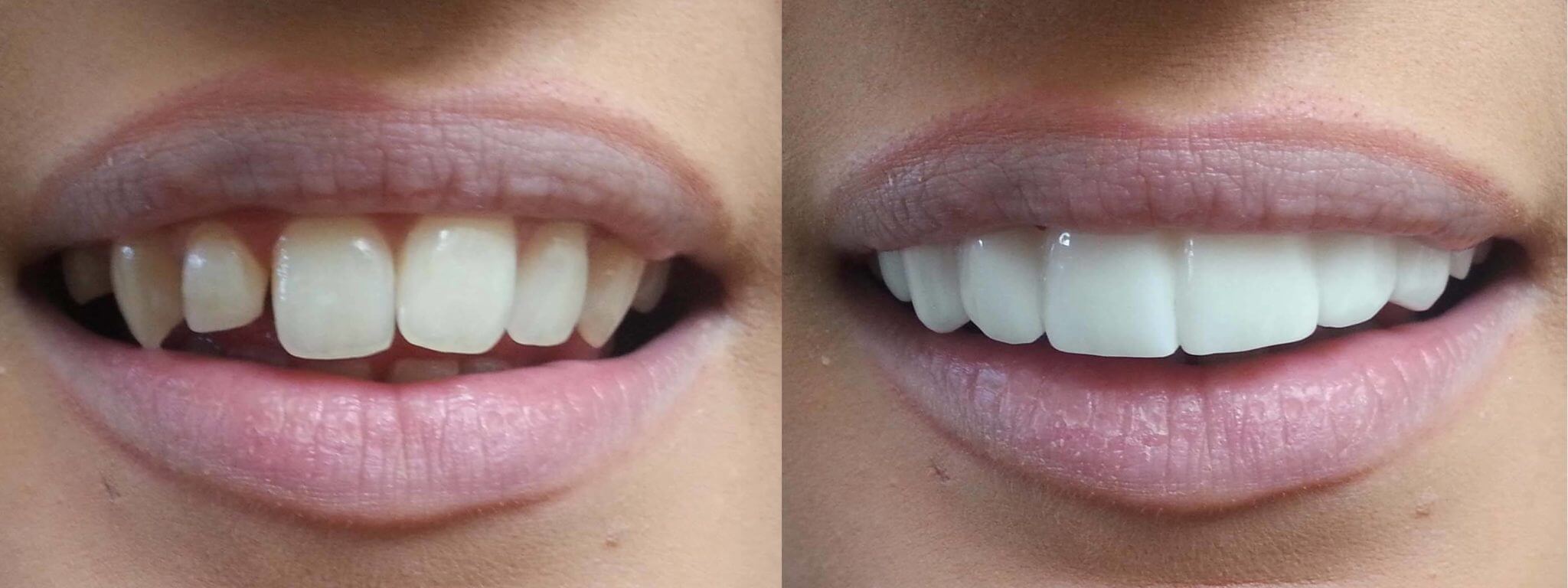 Do It Yourself Veneers - Removable Veneers For Your Teeth