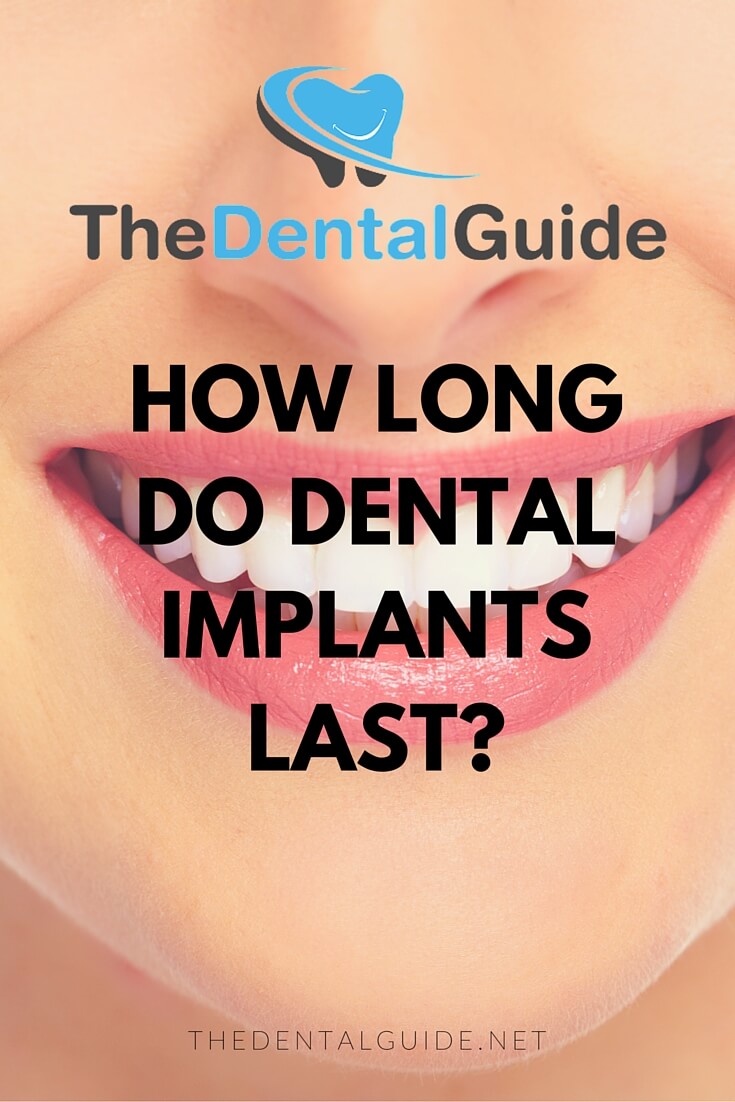 How Long Do Dental Implants Last? The Dental Guide