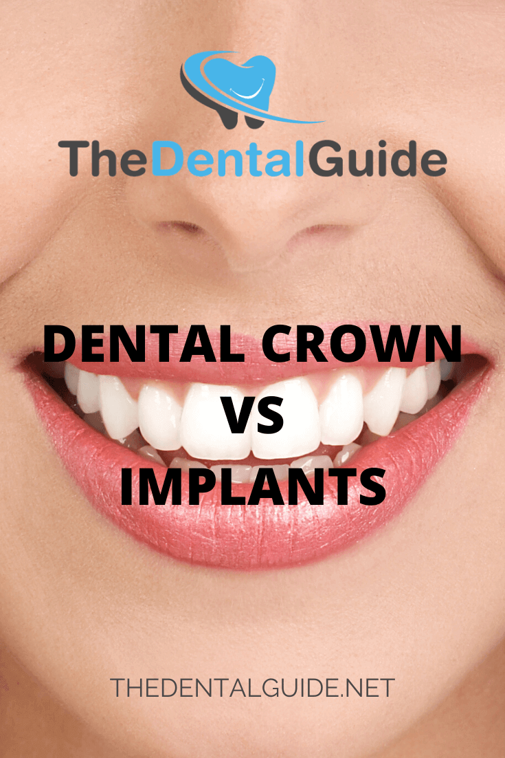 Dental Crown vs Implants - The Dental Guide