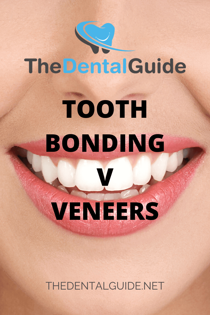 bonding veneers