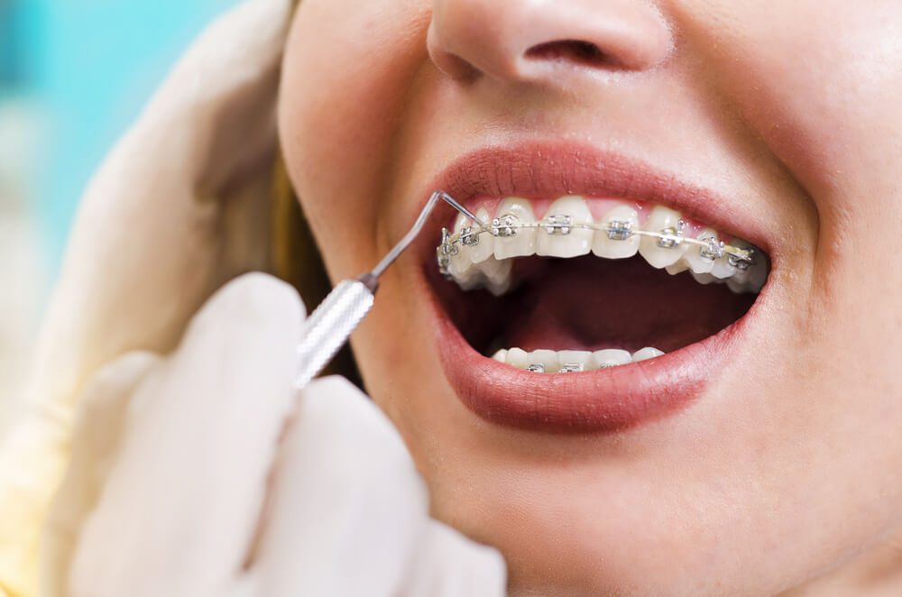 How Much Do Braces Cost in the UK? - The Dental Guide UK