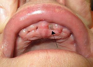 dry socket